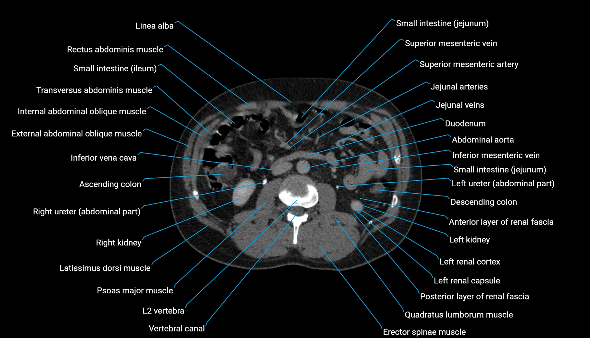 CT urogram axial cross sectional anatomy  labelled radiology image-00121.webp